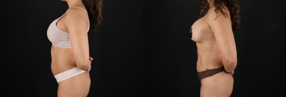 Liposuction case #6121