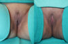 Labiaplasty case #5792 slider thumbnail