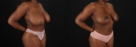 Breast Reduction case #8000