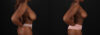 Breast Reduction case #8000 slider thumbnail