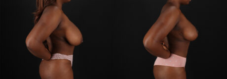 Breast Reduction case #8000