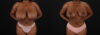 Breast Reduction case #8000 slider thumbnail