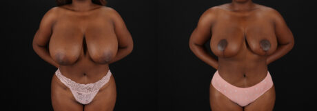 Breast Reduction case #8000