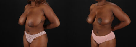 Breast Reduction case #8000