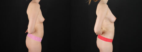 Fat Grafting to the Breast case #256214