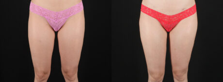 Fat Grafting to the Breast case #256214