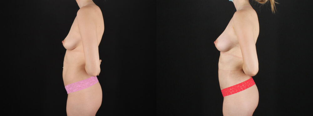 Fat Grafting to the Breast case #256214