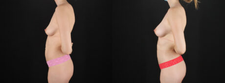 Fat Grafting to the Breast case #256214