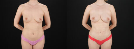 Fat Grafting to the Breast case #256214