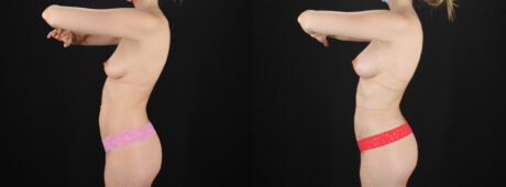 Fat Grafting to the Breast case #256214