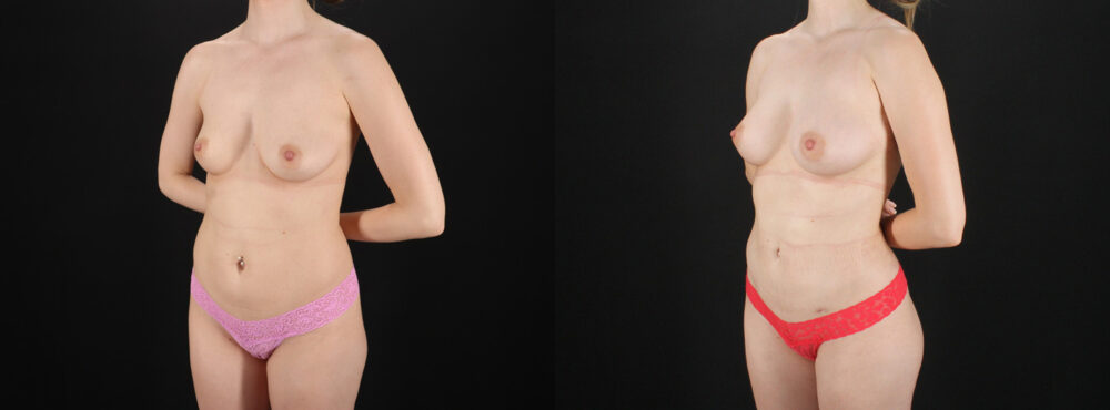 Fat Grafting to the Breast case #256214