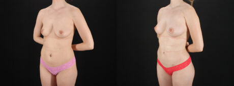 Fat Grafting to the Breast case #256214