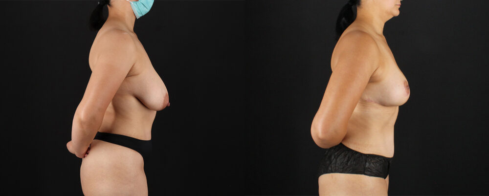 Breast Lift case #7792