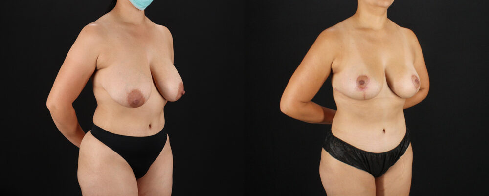 Breast Lift case #7792