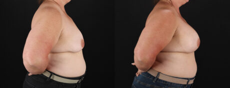 Breast Augmentation case #6450