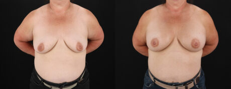Breast Augmentation case #6450
