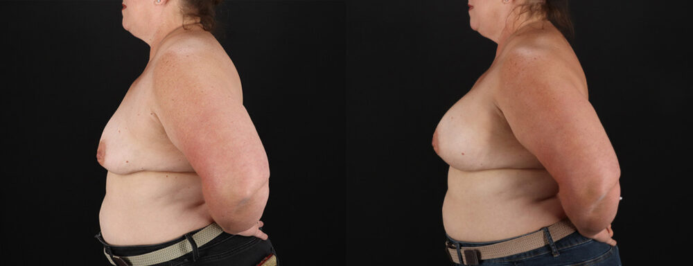 Breast Augmentation case #6450