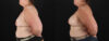 Breast Augmentation case #6450 slider thumbnail