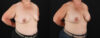Breast Augmentation case #6450 slider thumbnail