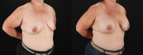 Breast Augmentation case #6450