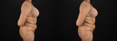 Brazilian Butt Lift case #5394