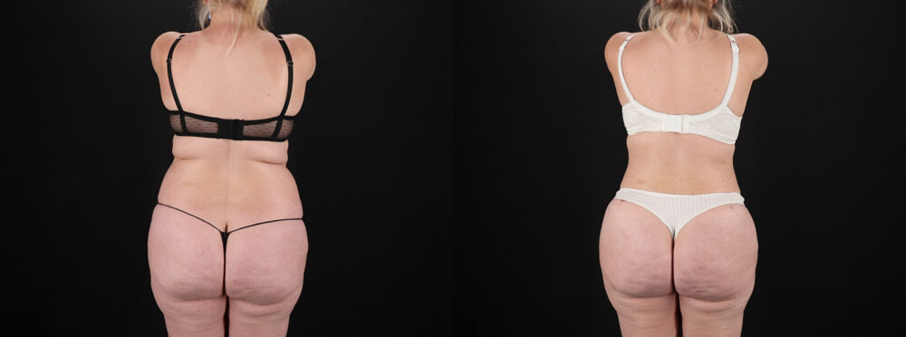 Brazilian Butt Lift case #5393