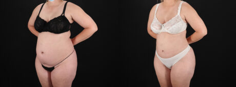 Brazilian Butt Lift case #5393