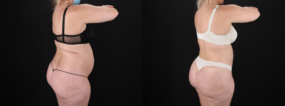 Brazilian Butt Lift case #5393