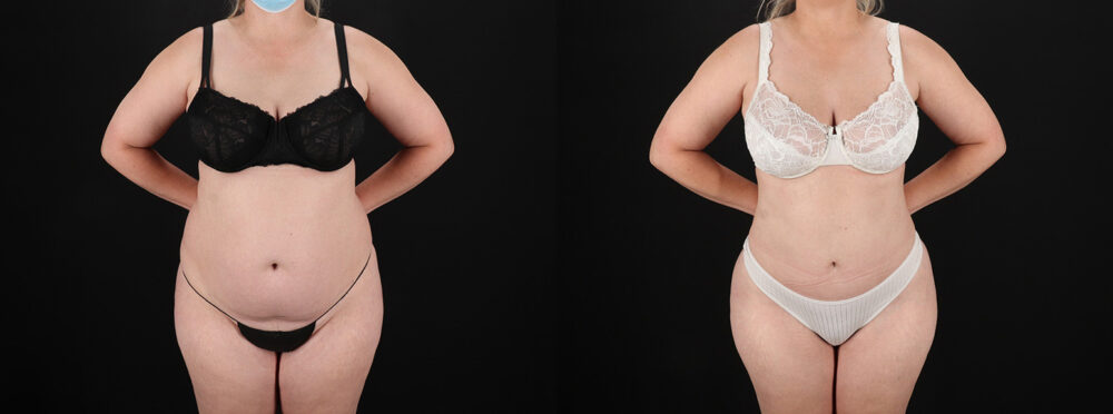 Brazilian Butt Lift case #5393