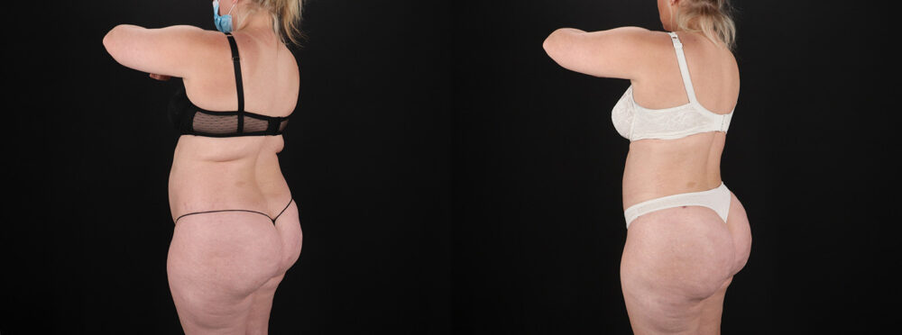 Brazilian Butt Lift case #5393