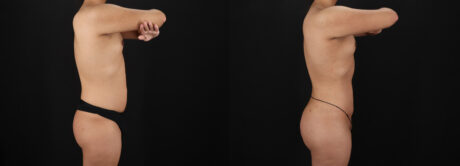 Brazilian Butt Lift case #5456