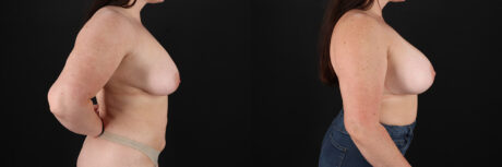 Breast Augmentation case #6426