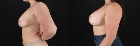 Breast Augmentation case #6426