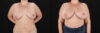 Breast Augmentation case #6426 slider thumbnail