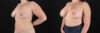 Breast Augmentation case #6426 slider thumbnail