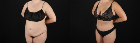 Tummy Tuck case #7621