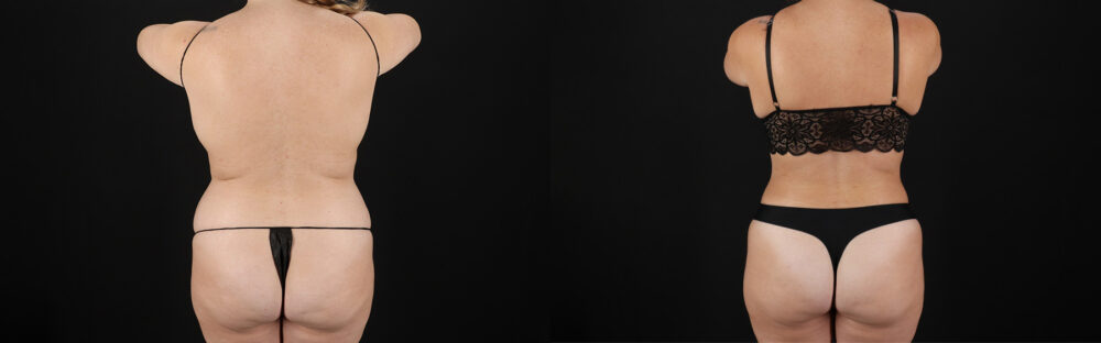 Tummy Tuck case #7621