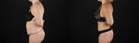 Tummy Tuck case #7621