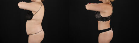 Tummy Tuck case #7621