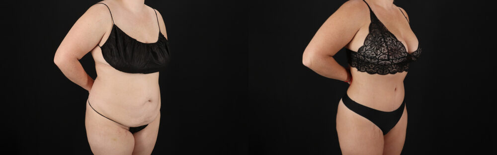 Tummy Tuck case #7621