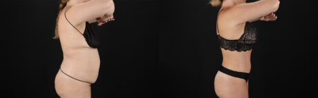 Tummy Tuck case #7621