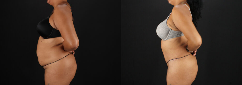 Tummy Tuck case #7616