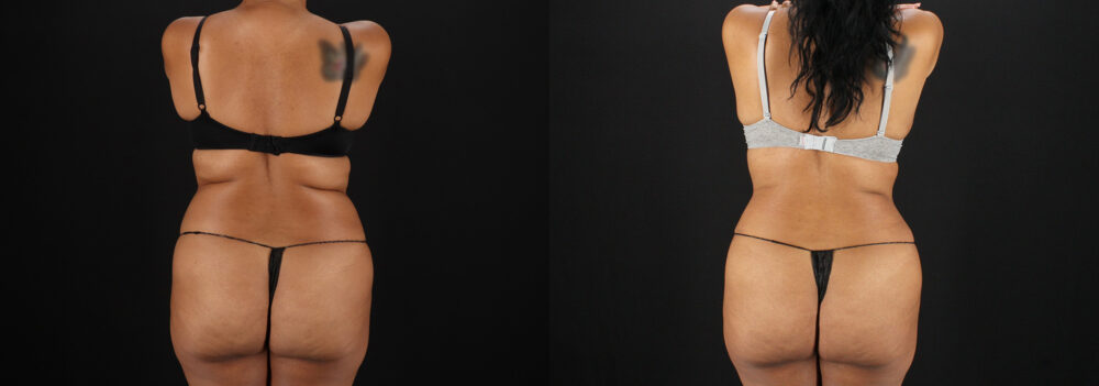 Tummy Tuck case #7616