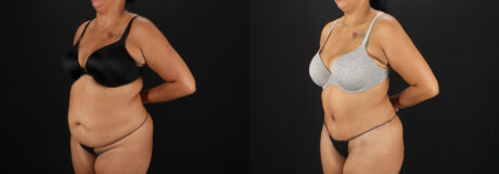 Tummy Tuck case #7616