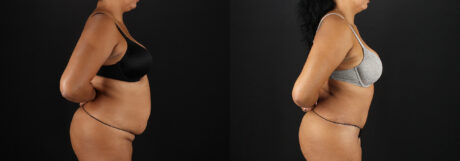 Tummy Tuck case #7616