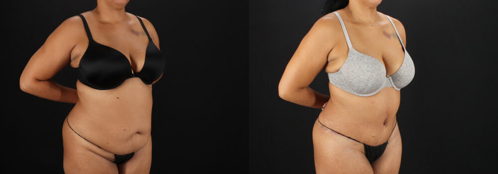 Tummy Tuck case #7616