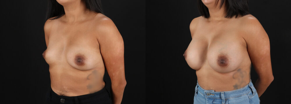 Breast Augmentation case #6456