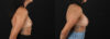 Breast Augmentation case #6456 slider thumbnail