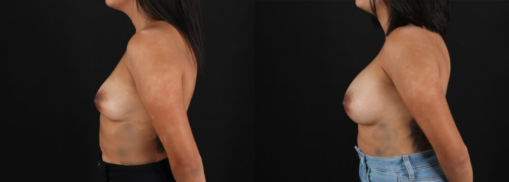 Breast Augmentation case #6456