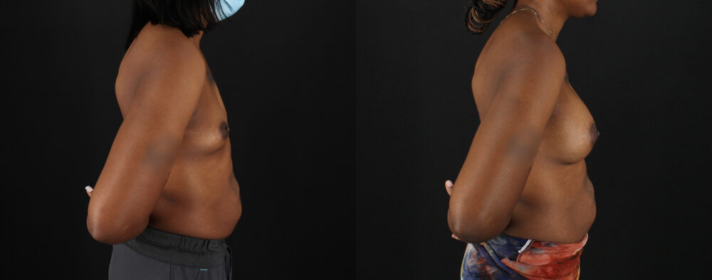 Breast Augmentation case #6432